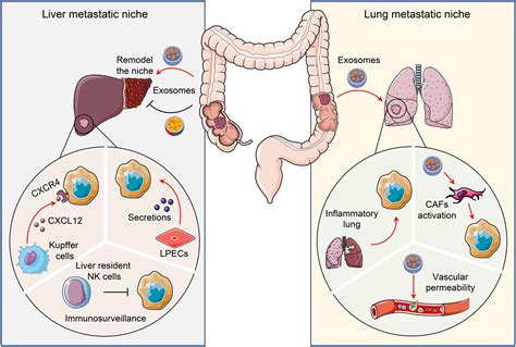 colon mets|colon cancer most common metastasis.